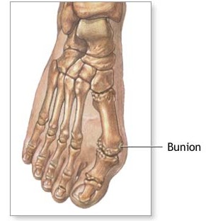 Bunion surgery Mexico