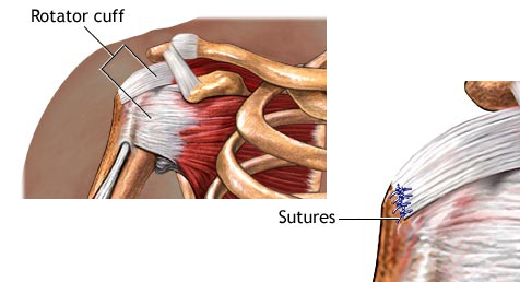 Rotator cuff repair Mexico Rotator cuff surgery in Mexico is within the 