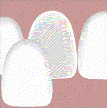Teeth veneers
