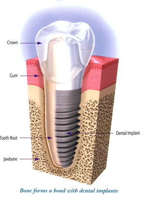 teeth-implants teeth implants