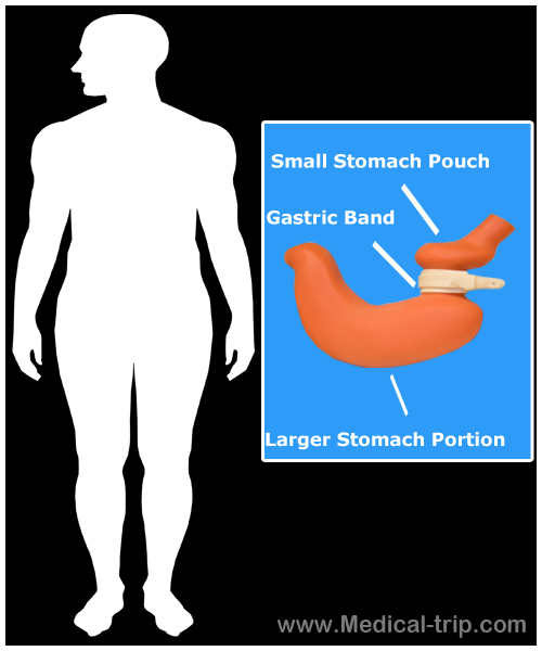 Lap Band Surgery in Las Vegas