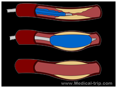 Venous Angioplasty India