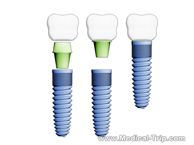 dental-implants Dental Implants