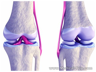Knee Surgery India Knee Surgery India