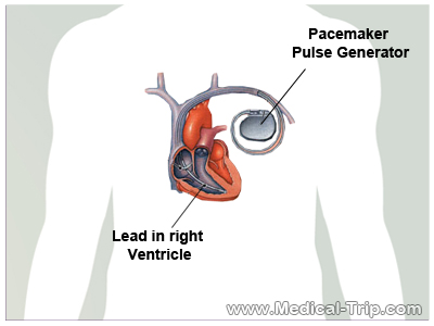 pacemaker surgery India pacemaker surgery India