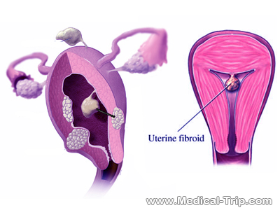 uterine fibroids