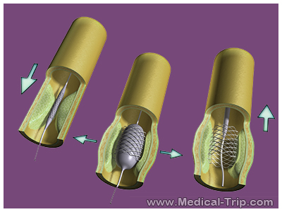 Venous Angioplasty for MS in India Venous Angioplasty for MS in India