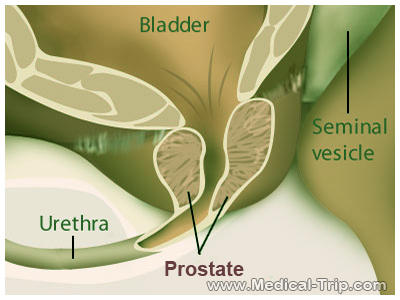cancer Prostate Cancer