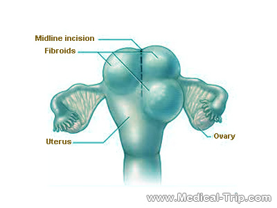 Myomectomy Myomectomy