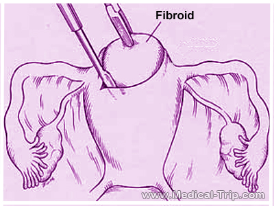 Firboid in Uterus Firboid in Uterus