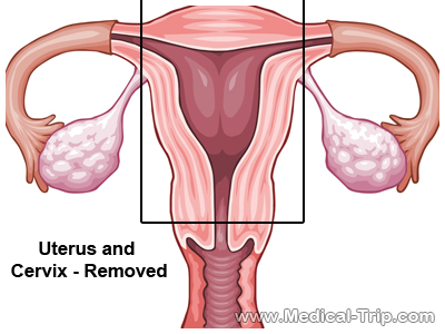 uterus-and-cervix-removal-surgery uterus-and-cervix-removal surgery India