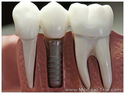 Dental Implants Dental Implants