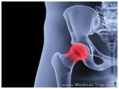 Hip Replacement Hip Replacement