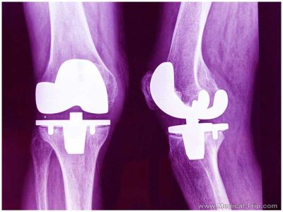 Knee Surgery Knee Surgery