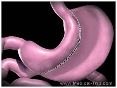 Vertical Sleeve Gastrectomy