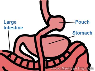Gastric Bypass Surgery