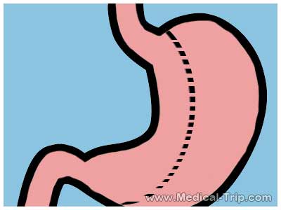 Gastric Sleeve Surgery