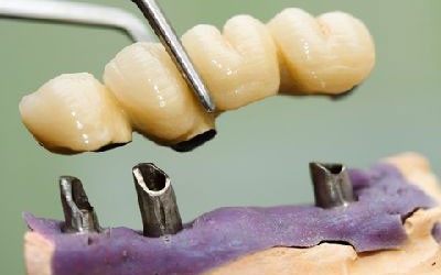 Dental Implants in Thailand