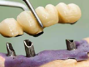 Dental Implants in Thailand