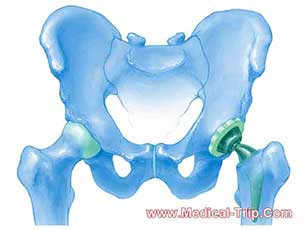 Hip Replacement Surgery in Tijuana - Mexico