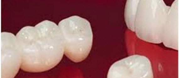 CAD CAM Dental Crowns - Costa Rica