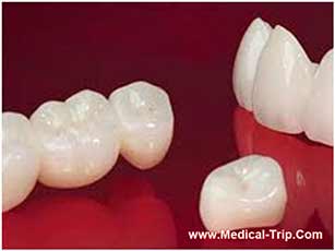 CAD CAM Dental Crowns - Costa Rica