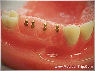 Dental Implants for Missing Teeth